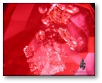 Guest crystals in un-treated Mogok ruby.